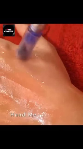 Meso-Needling