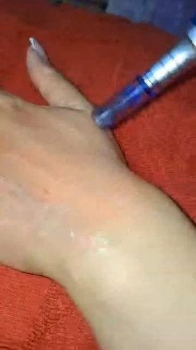 Meso-Needling جوانسازی دست تنها با چند جلسه