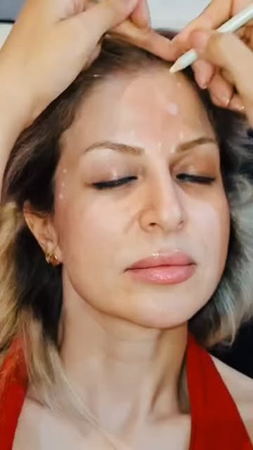 بوتاکس