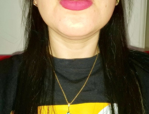 مزوتراپی غبغب